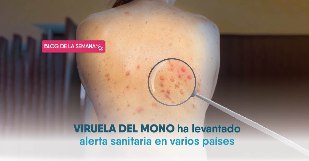 oftalmologia marzo 04 - Perú dispone en alerta epidemiológica por viruela del mono